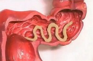 die Behandlung von Würmern
