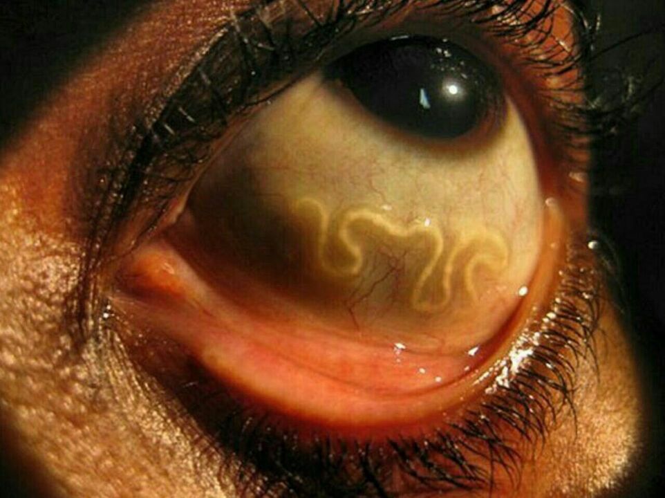 Parasiten im menschlichen Auge